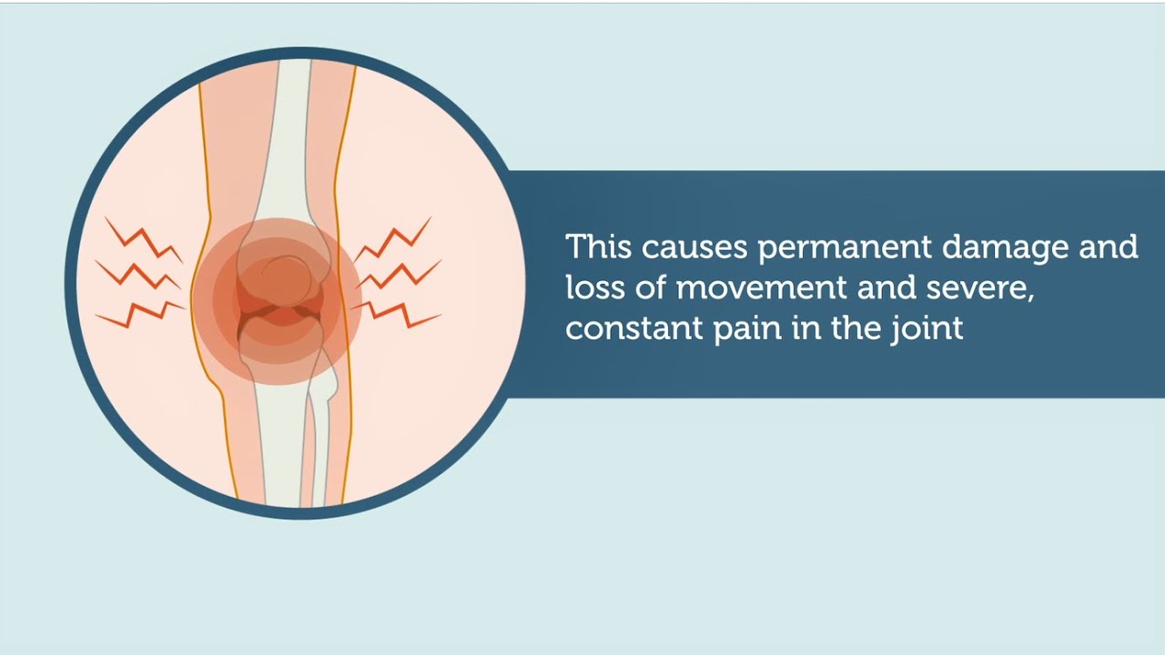 What is a joint bleed?
