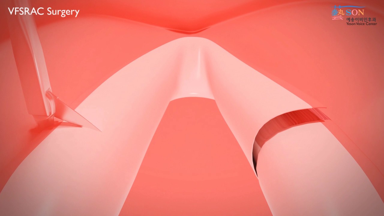 Yeson VOice Center - VFSRAC SURGERY TECHNIQUE IN 3D VIDEO