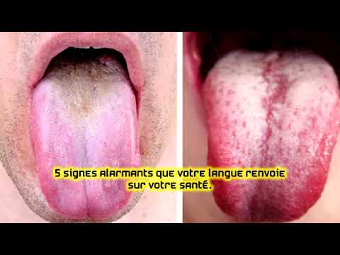 Vidéo: Causes De La Plaque Jaune Sur La Langue D'un Enfant