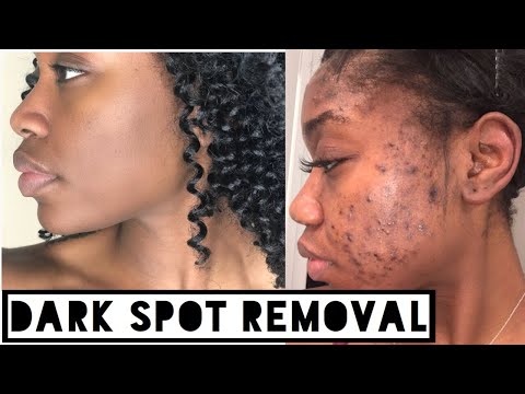 SKIN| How to Get Rid of Dark Scars (Hyperpigmentation) & Acne Scars at Home (No Click Bait)