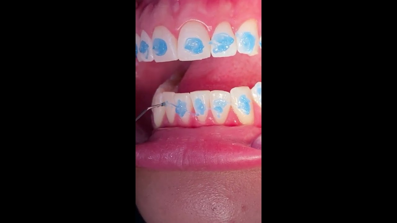 What Happens If You Get Braces A Second Time Tooth Family Dentistry New Braunfels Texas