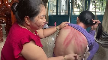 ￼￼ cô tám cạo gió cho cô loan@￼ ở long Xuyên