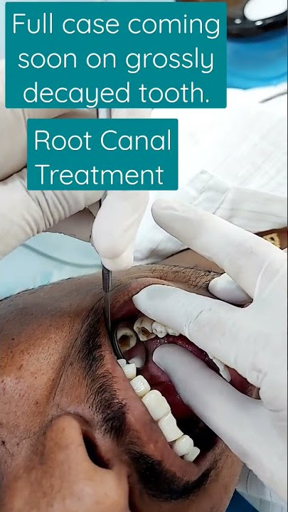 #rootcanaltreatment #toothcavity @JawTooth