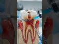 Root Canal Treatment Step-by-Step: Infected Tooth Nerve Fixed! 🦷