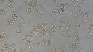 Rouleax formation of RBCs