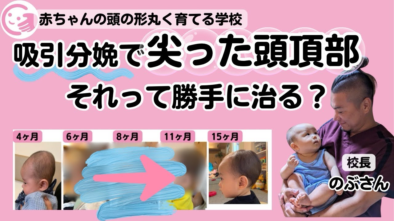 吸引 分娩 頭 の 形