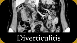 Imaging diagnosis of Diverticulitis (CT/MRI)