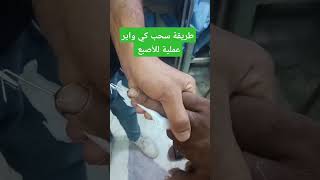 طريقه سحب كي واير عملية جراحية في الأصبع المكسور