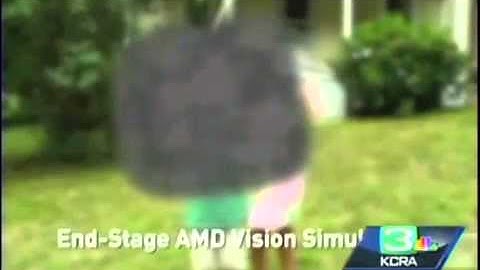 Sacramento KCRA: CentraSight for age-related macular degeneration (AMD)