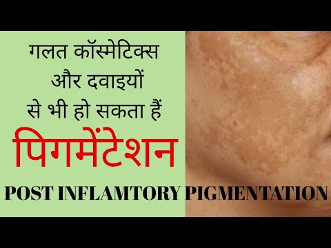 गलत कॉस्मेटिक्स और दवाइयों से हो सकता हैं पिगमेंटेशन। by Dr. Manoj Das