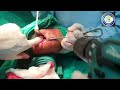 Elastic nailing humerus  humerus fracture  spiral communited fracture humerus  adamya hosp vid