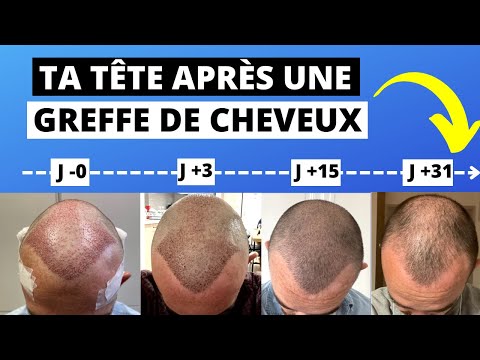 Vidéo: À quoi ressemble la vie après la greffe ?