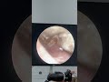 Insane Earwax Extraction 😳 | Giant Build-Up Cleared Safely #Medical #ENTClinic #Shorts