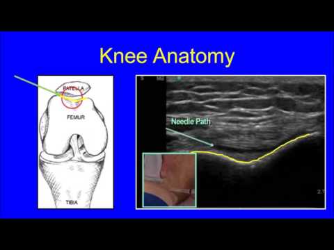 Overview of Ultrasound Guided Injections for Pain Relief