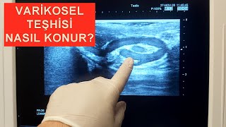 Varikosel Teşhisi: Normal Testis Damar Yapısı ve Varikosel olan Testis Damar Yapısı Karşılaştırması Resimi