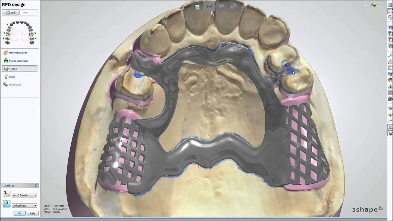 Dental System 2013: Removable Partial Design - YouTube