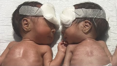 NICU newborn Premature twins sleeping 🛌 😴 |  Specific topics |  Premature baby support |