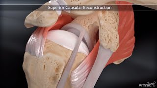 Superior Capsular Reconstruction Animation