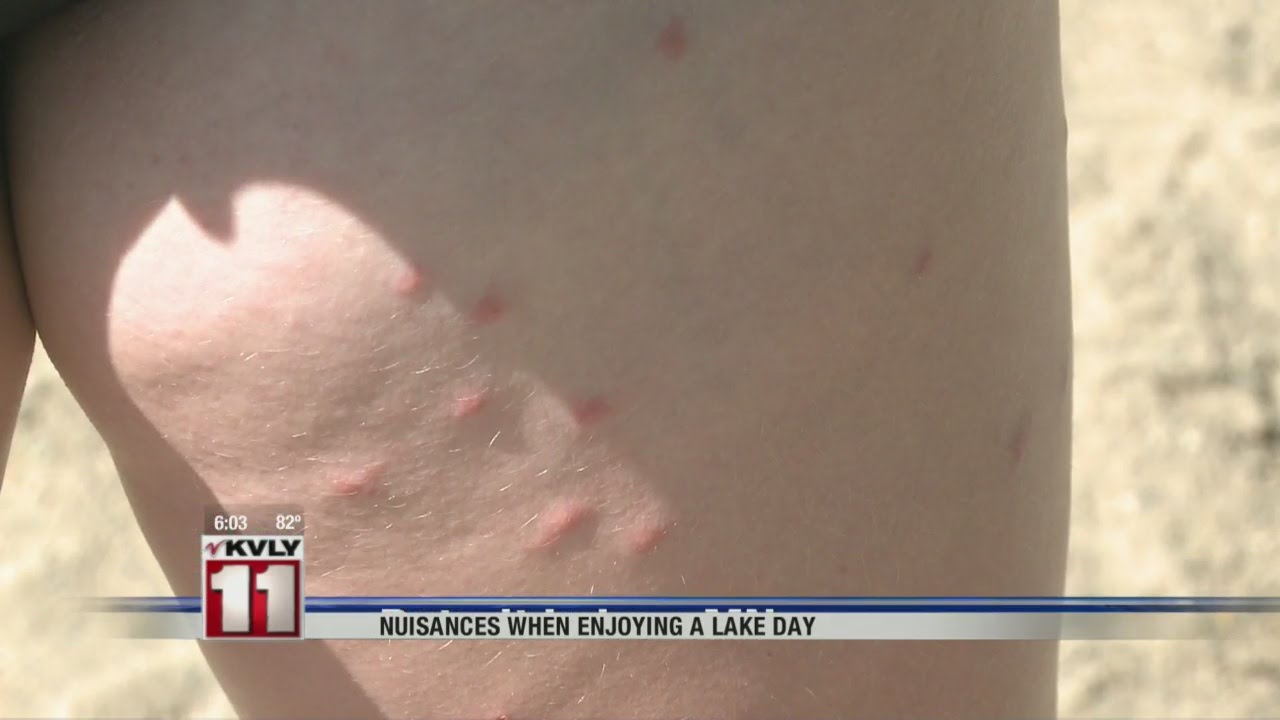 Combating Swimmer S Itch Youtube