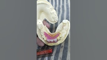 Lower Interior 3 Unit Removable Partial Denture Ready for Flasking 😁😁😁#rpddentalprocedure