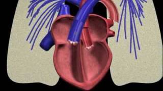PFO closure animation