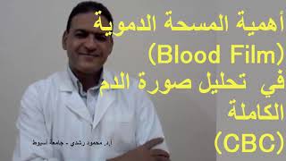 أهمية المسحة الدموية  في تحليل صورة الدم الكاملة !!Importance of blood smear in CBC