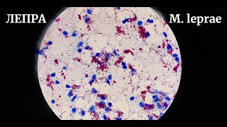 Лепра (Mycobacterium leprae) Морфология, Патогенез, Клиника, Лабораторная Диагностика и Профилактика