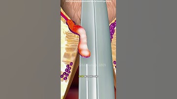 How hemorrhoid removal surgery is performed?(3D animation) #drone #theflash #space #automobile