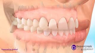 Carriere Distalizer Correcting Overbites and Class 2 Malocclusions