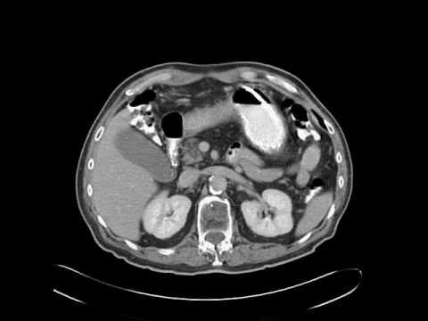 Scirrhous gastric adenocarcinoma signet ring cell type