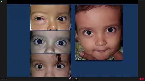 UPDATE SERIES ON OCULOPLASTY   Dr Vikas Menon