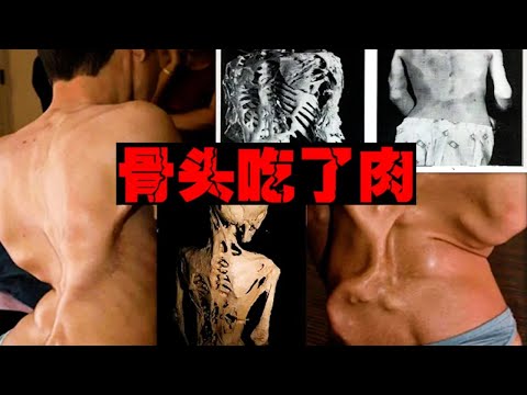 【石人综合症】肉体骨化压穿内脏，患者被锁死动弹不得【郑郑得证】