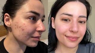 AUSTRALIAN SKINCARE FAVOURITES 2024 | Acne-Prone Skin w/ Scarring | Boring Without You, Tbh Skincare