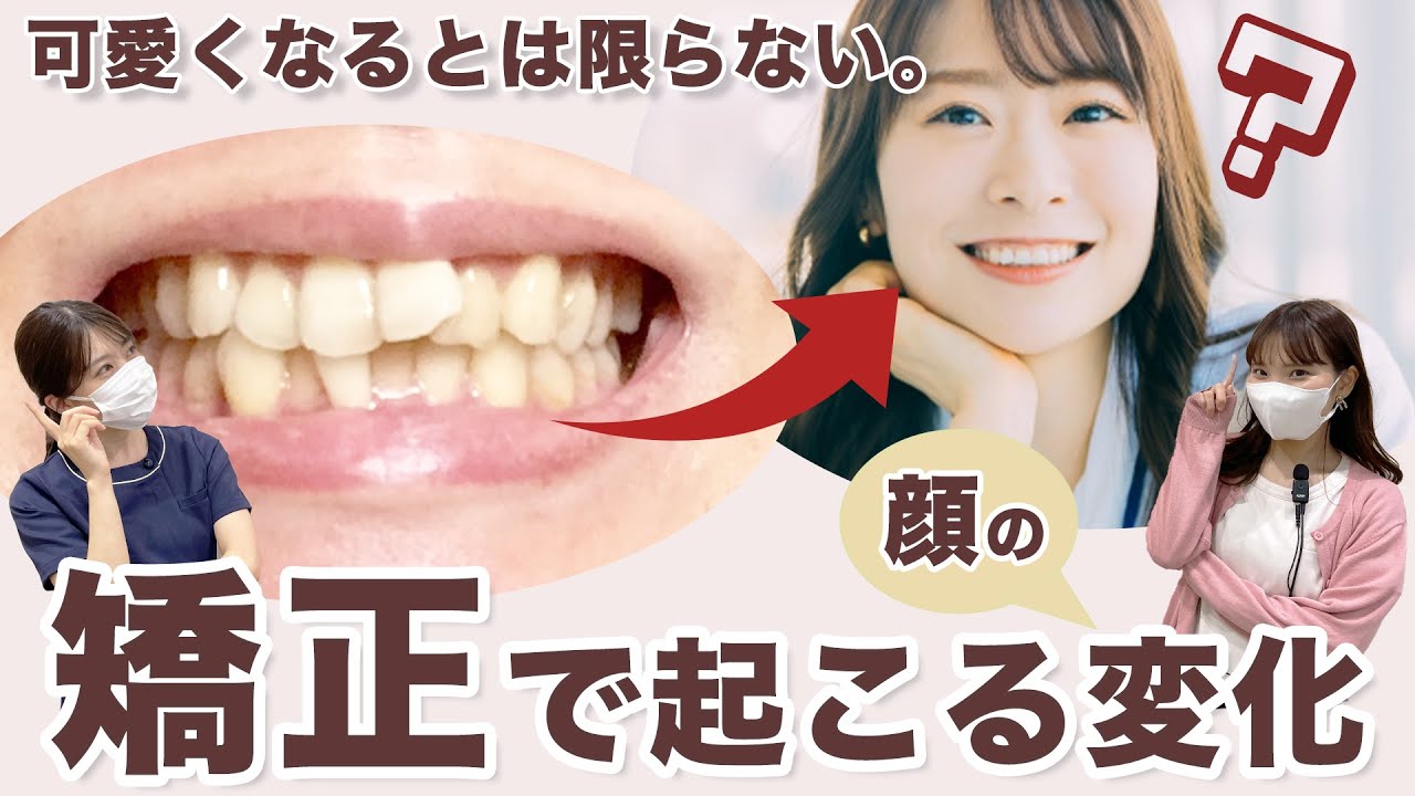 【矯正でブスになる？！】歯列矯正で頬ゴケ・人中伸び・ほうれい線が起こる？アンケートをもとに体験談を交えて解説【前編】