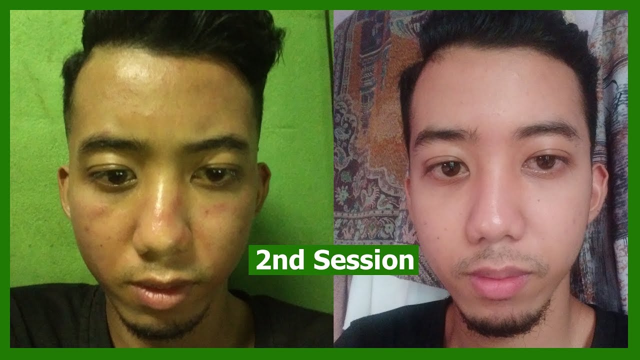 Microneedling Treatment 2nd Session Before & After YouTube