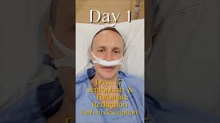 I Got A Septoplasty & Turbinate Reduction (Recovery Vlog) *LINK IN DESCRIPTION*