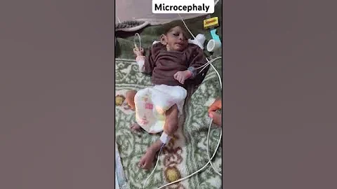 Microcephaly #medicalstudent #nicu #icu #parenting #medicine #pediatrics #mbbs #fyp #viral #nurse