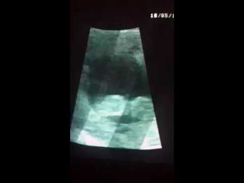 Movimientos bebe,ecografia 4 meses/Baby movements, ultrasound 4 months costura armchair