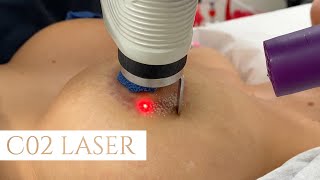 Get Your Scars Removed With This Secret Laser! - C02 Laser Resurfacing at Barrett Plastic Surgery