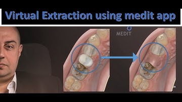 virtual extraction using medit app