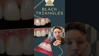 Black Triangles Between Teeth and How to Fix Them