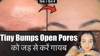 7 Days Challenge : Tiny Bumps Open Pores ग़ायब, पायें CLEAN HYDRATING और GLOWING SKIN | DIY Facial