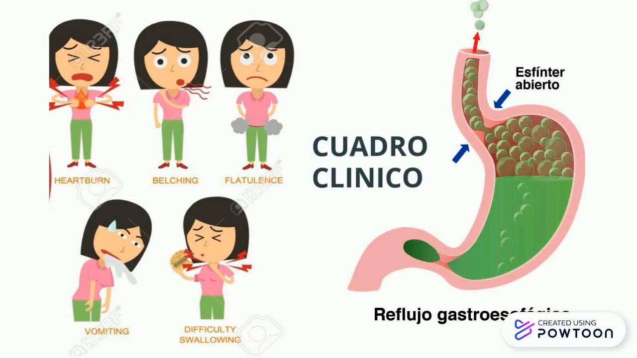 sintomas de reflujo esofagico