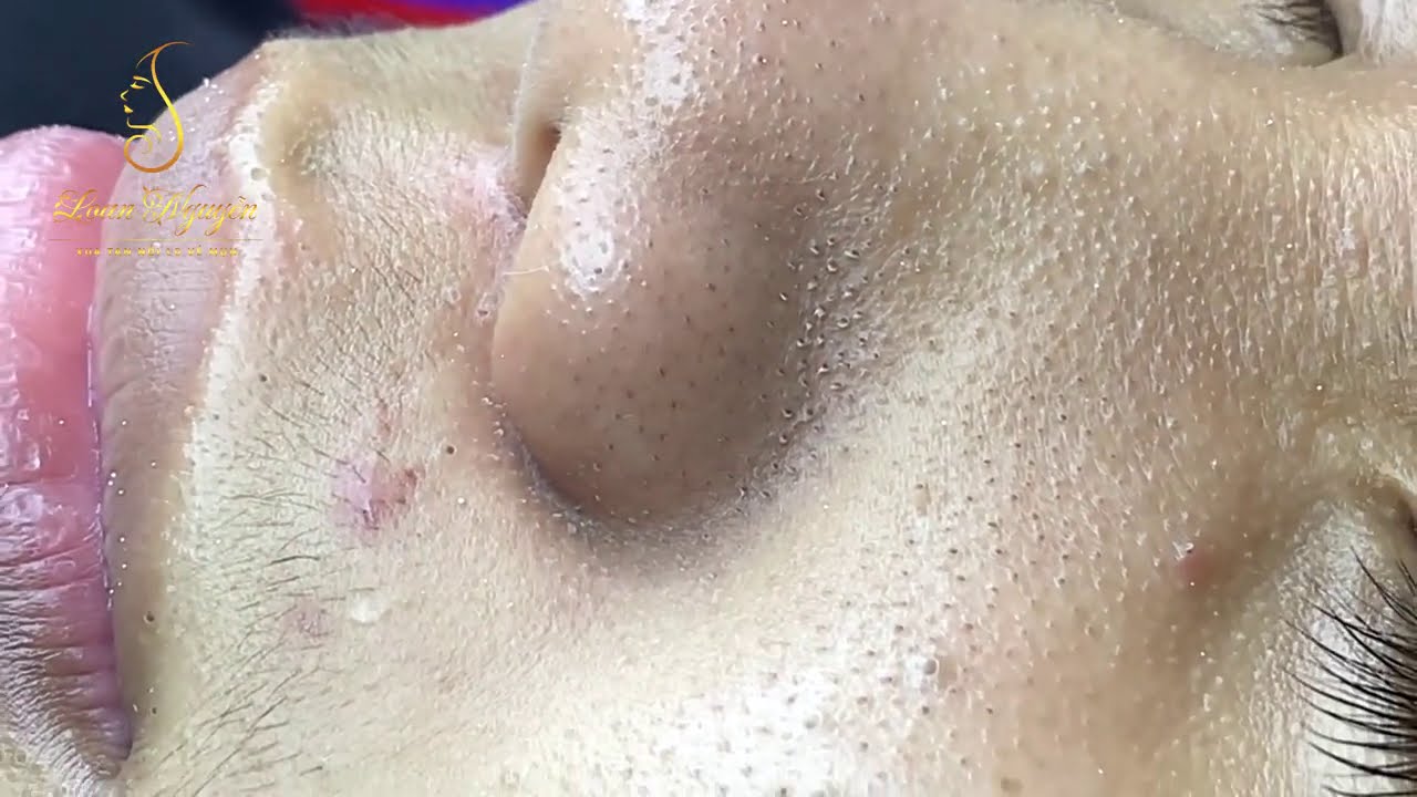 Blackheads removal (316) | Loan Nguyen