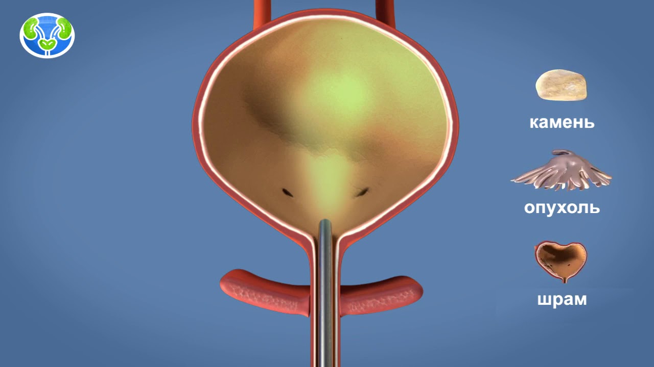 Эндоскопия мочевого пузыря - YouTube