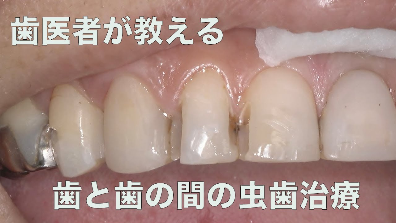 歯 と 歯 の あいだ の 虫歯