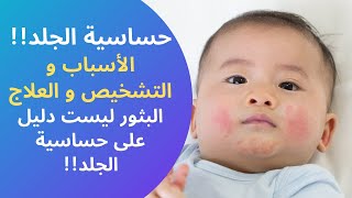 حساسية الجلد! الأسباب و التشخيص و العلاج! ليست أي حكة أو بثور في الجلد تعتبر حساسية!!