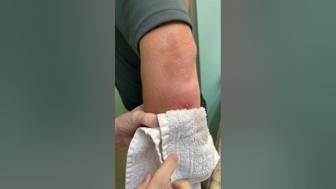 Botfly removal human botfly maggot removal shorts botfly 