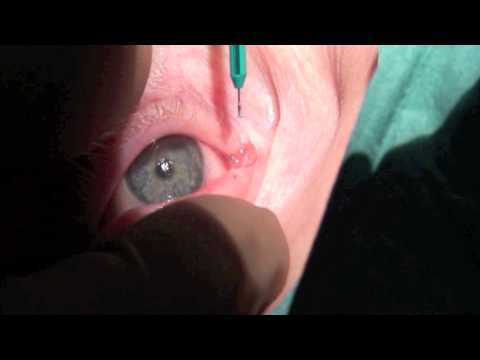 Video: Presbyopia I øyet - Symptomer, Diagnose, Behandling, Kirurgisk Korreksjon