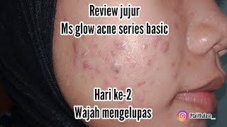 REVIEW MS GLOW ACNE SERIES | HARI KE-2| WAJAH MENGELUPAS | My Acne Story